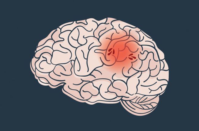 cara merawat minor stroke