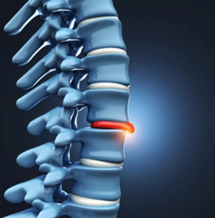 Cara check slip disc